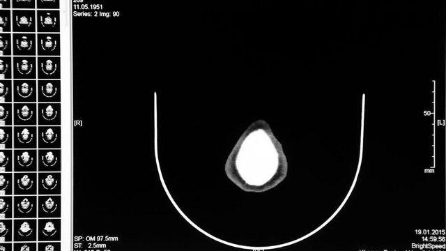 Multispectral computed tomography of the head