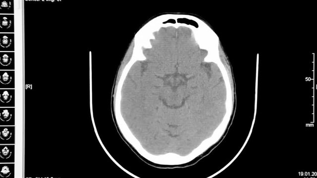 Multispectral computed tomography of the head