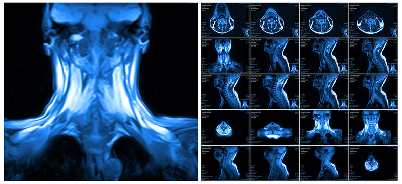 Magnetic resonance imaging of the cervical spine.
