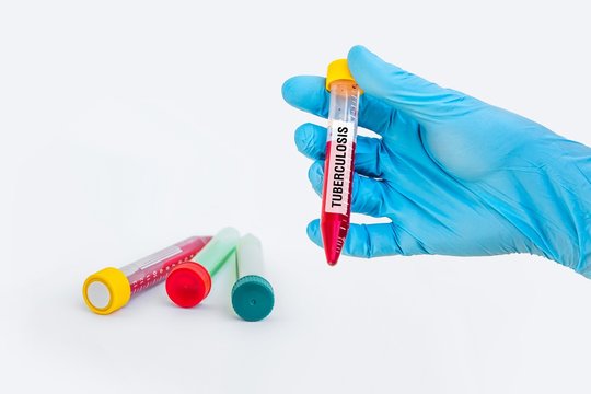 Test-tube With Blood Sample For TUBERCULOSIS Test