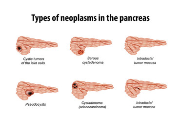 Types of neoplasms in the pancreas. Infographics. Set. Vector illustration on isolated background