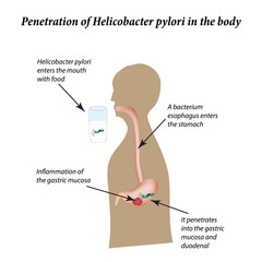 Infection with Helicobacter pylori. Infographics. Vector illustration on isolated background