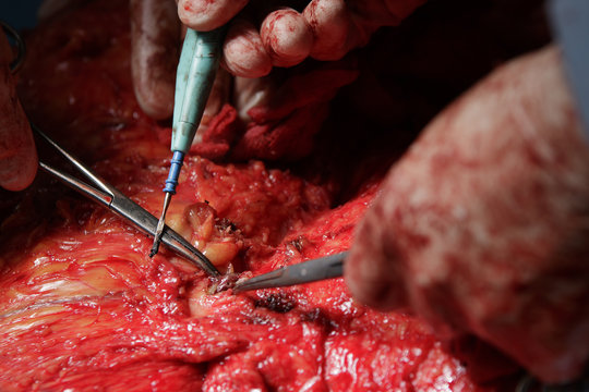 Cauterize vessel close-up in stomach surgery