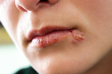 Oral herpes infection