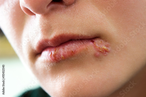 Oral Herpes Infection Stockfotos Und Lizenzfreie Bilder Auf Fotolia