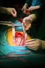 coronary artery bypass grafting