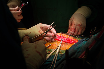 closure sternum bone with metal wires