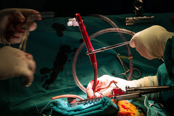 coronary artery bypass grafting