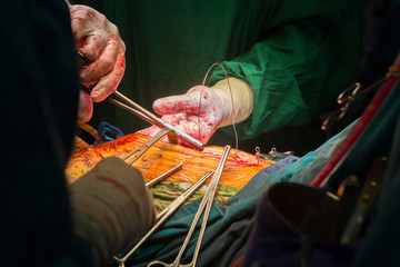 closure sternum bone with metal wires