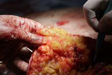 Huge piece of fat cutting of with surgeon hand holding it close-up