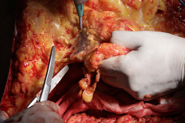 Surgeon cuts off a piece of fat tissue with surgical scissors during the operation