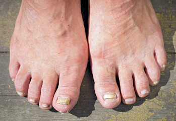 onychomycosis with fungal nail infection