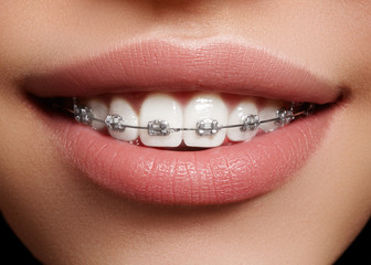 Beautiful macro shot of white teeth with braces. Dental care photo. Beauty woman smile with...