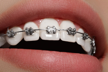 Beautiful macro shot of white teeth with braces. Dental care photo. Beauty woman smile with...