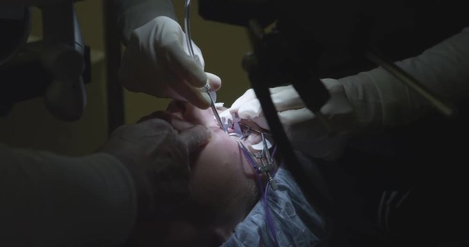LASER EYE SURGERY STEP 6: Mechanical blade cutting corneal flap