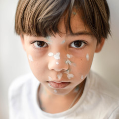 Young kid sick with chicken pox, white and green antiseptic cream applied. Chickenpox is the Herpes...