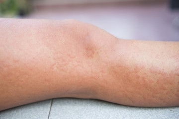 Allergic reactions caused by urticaria