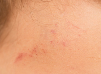 Fototapeta premium abrasion on the skin