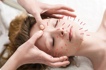 Woman undergoing acupuncture treatment - obrazy, fototapety, plakaty