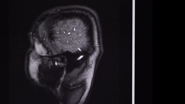 MRI brain scan, side view, top view