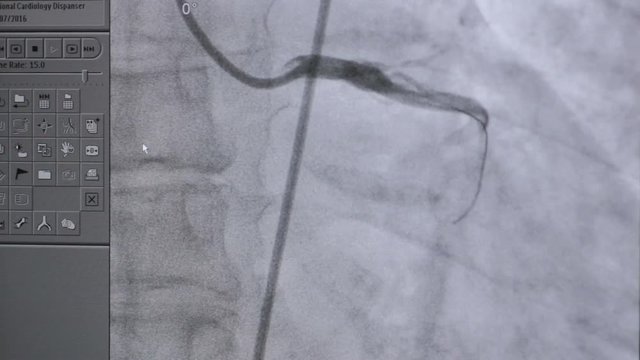 Ultrasound of a Real heartbeat. Ultrasonic examination on computer screen. 1080p.