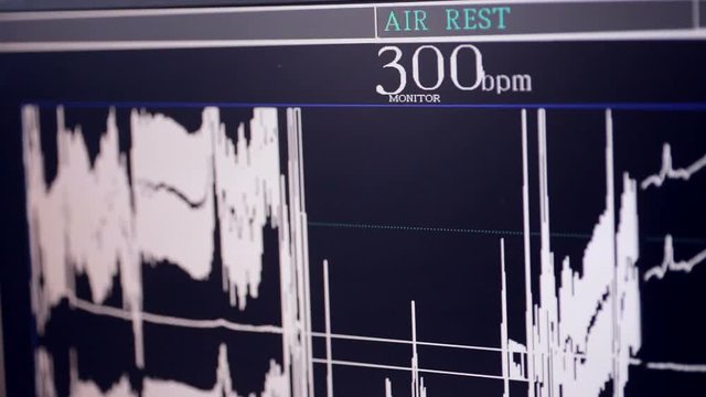 Real Cardiogram. Working cardiograph in a cardiology hospital. 1080p.