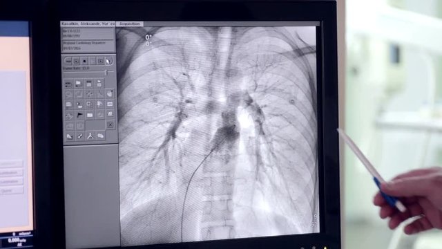 Ultrasound of a Real heartbeat. Ultrasonic examination on computer screen. 1080p.