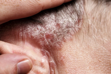 Psoriasis, psoriatic skin disease