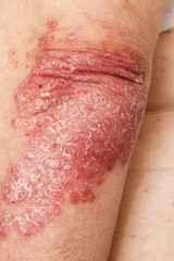 Fototapeta premium Psoriasis, psoriatic skin disease