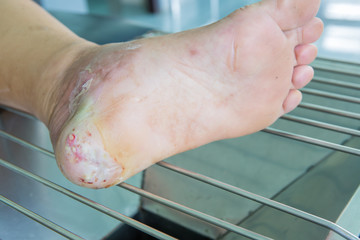 wound of diabetic foot