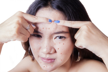 Teenage girl squeezes acne on her forehead