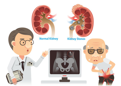 Kidney Stones/Doctors are advising the old kidney stones.
He with pain. Vector cartoon illustration