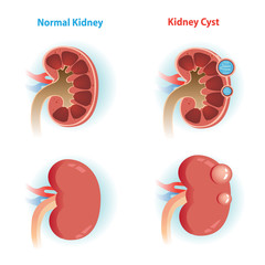 kidney Cyst/kidney Cyst disease and  Normal kidney.Vector illustrations