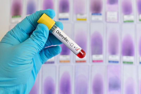 Blood sample positive with Chlamydia trachomatis bacteria
