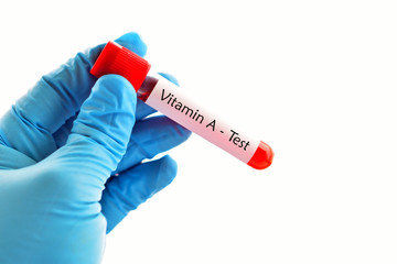 Obraz premium Test tube with blood sample for vitamin A test 