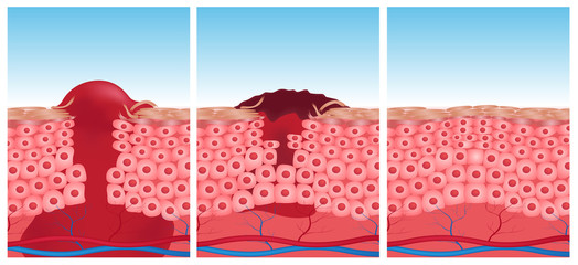 wound skin vector graphic . blood come out of wound  - obrazy, fototapety, plakaty