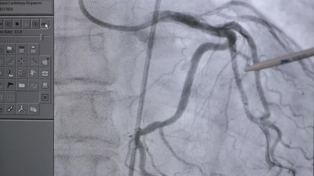 X-ray real Heart in action. HD.