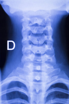 Neck and spine injury xray scan