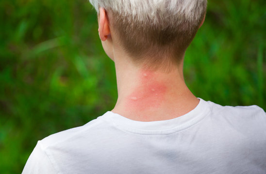 mosquito bites.Girl with blond hair,sitting with his back turned and scratching bitten,red neck skin from mosquito bites in the summer in the forest.Close-up of visible insect bites.Irritated skin
