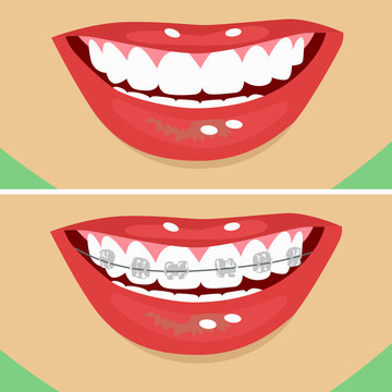 Dental Braces, Before And After