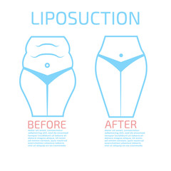 Liposuction before and after infographics