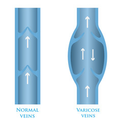 varicose veins