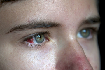 model released image of caucasian boy, close up on eye with allergic reaction to surgical suture...