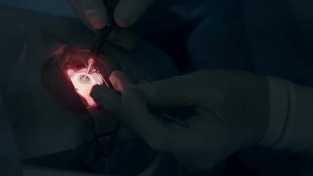 Macro Image of Eyes on Displays During Eye Surgery. Creepy Ophthalmological surgery. HD.