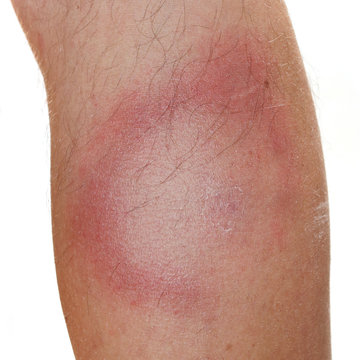 An Erythema Migrans rash often seen in the early stage of Lyme disease. It can appear after a tick or mosquito bite. It is an actual skin infection with the Lyme bacteria, Borrelia burgdorferi.