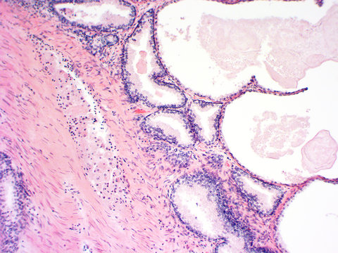 Prostate microscopic photograph zoom x100