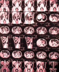 Kidney magnetic resonance image