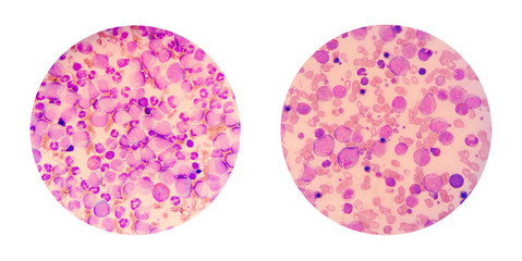 Microscopic views of a blood smear from leukemia cancer patient 