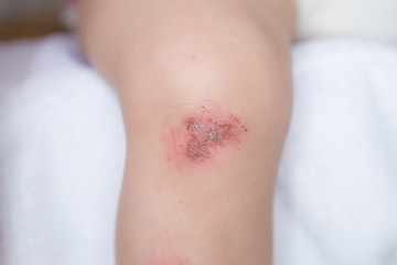 Fototapeta premium Wunde am Knie eines kleinen Kindes