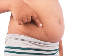 little pointing scar after appendectomy